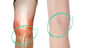 The Knee Pain Relief method