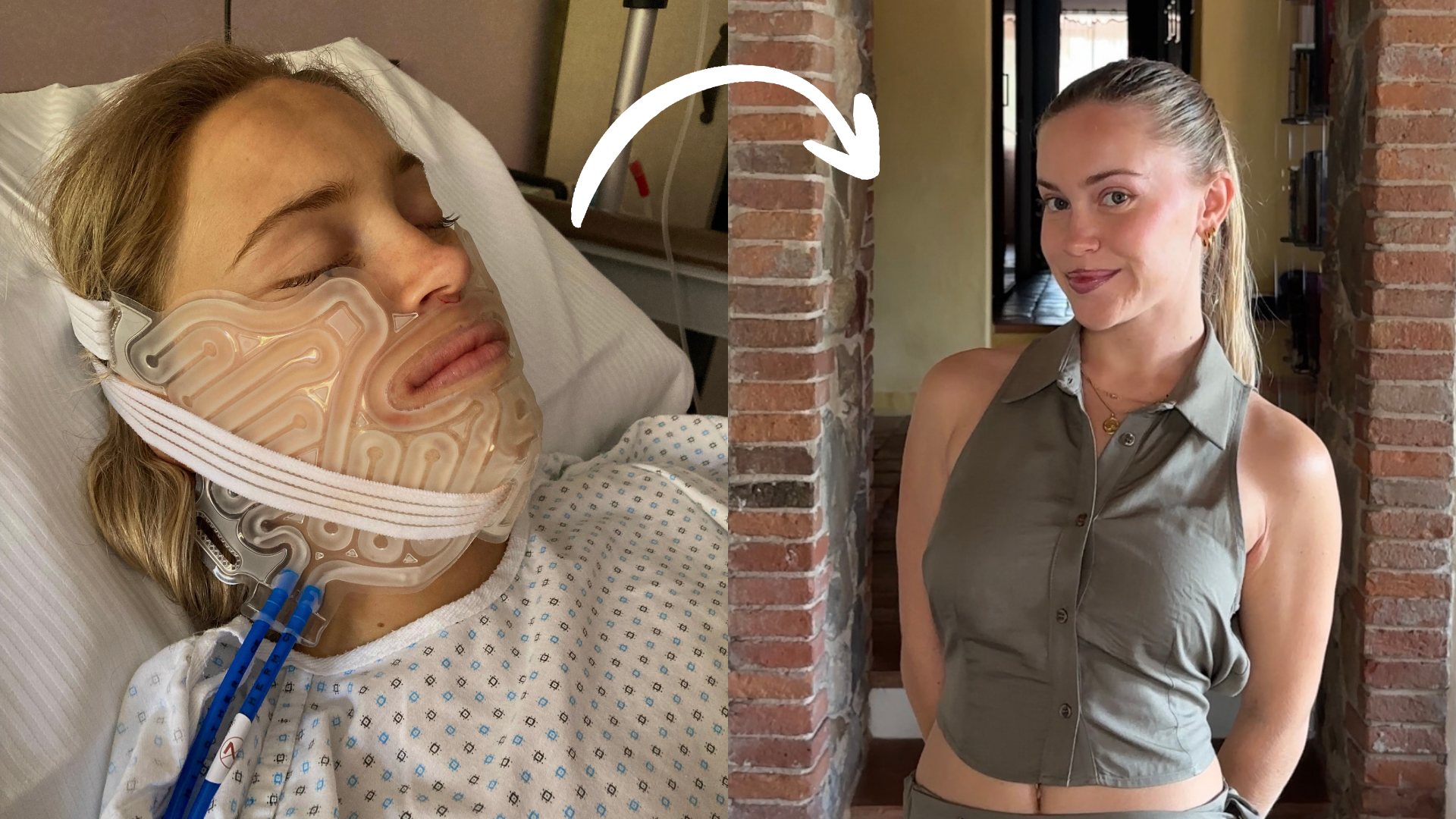 My Complete Jaw Surgery Guide