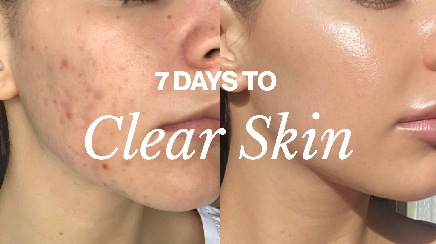 7 Days To Clear Skin Course