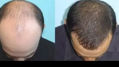 A 7 day guide for men over 40 who are dealing with thinning