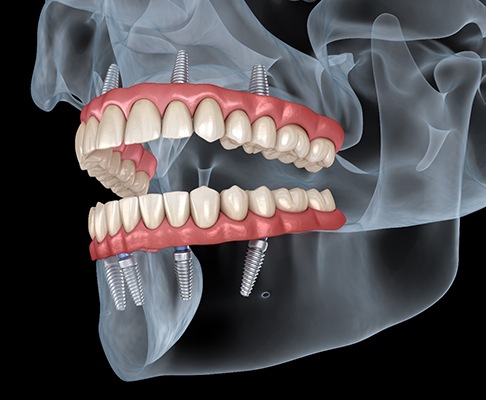 Dental Implant
