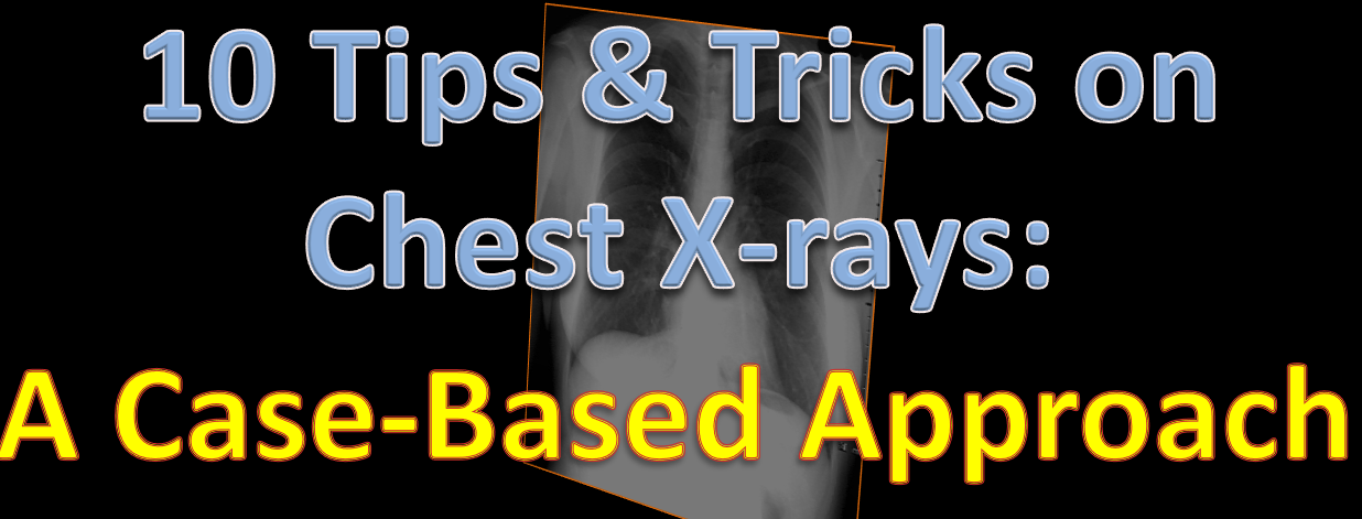 10 Tips and Tricks on Chest X-Ray